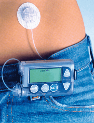 Medtronic MiniMed Paradigm VEO инсулиновая помпа с непрерывным мониторингом глюкозы