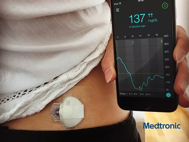 Medtronic Guardian Connect система непрерывного мониторинга глюкозы